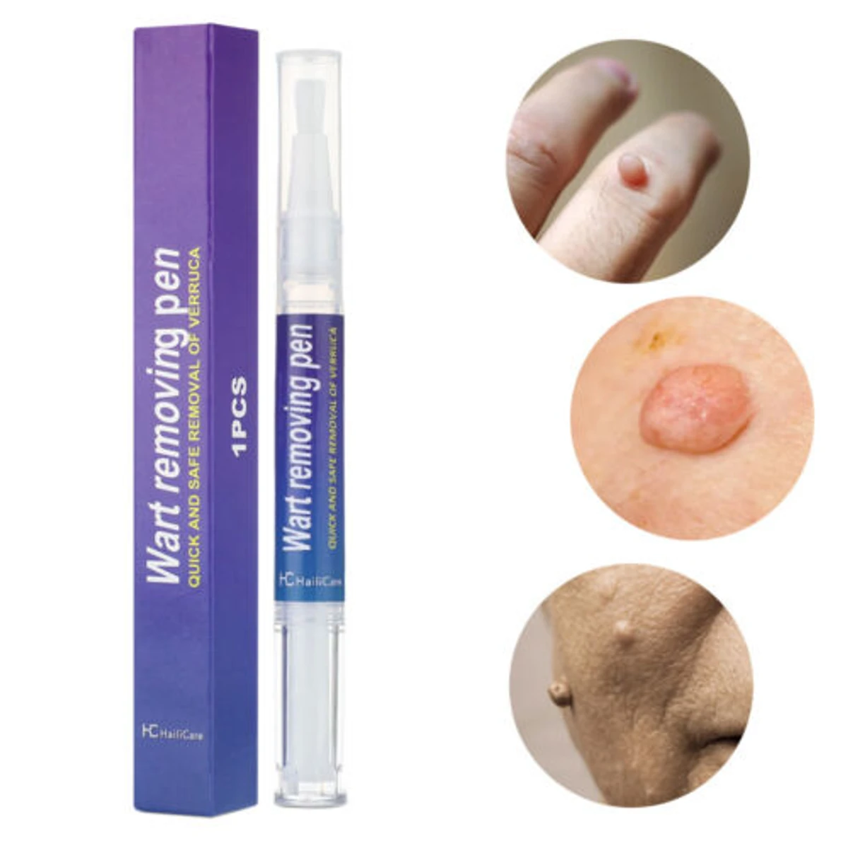 Wart Remover Pen